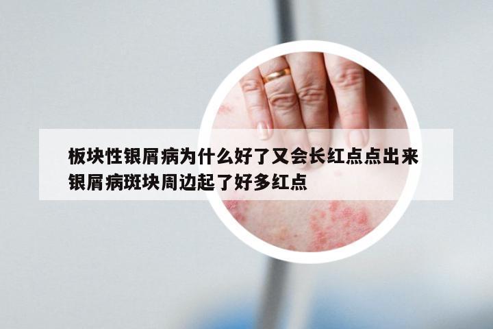 板块性银屑病为什么好了又会长红点点出来 银屑病斑块周边起了好多红点