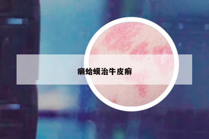 癞蛤蟆治牛皮癣