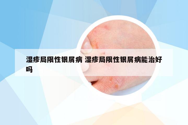 湿疹局限性银屑病 湿疹局限性银屑病能治好吗
