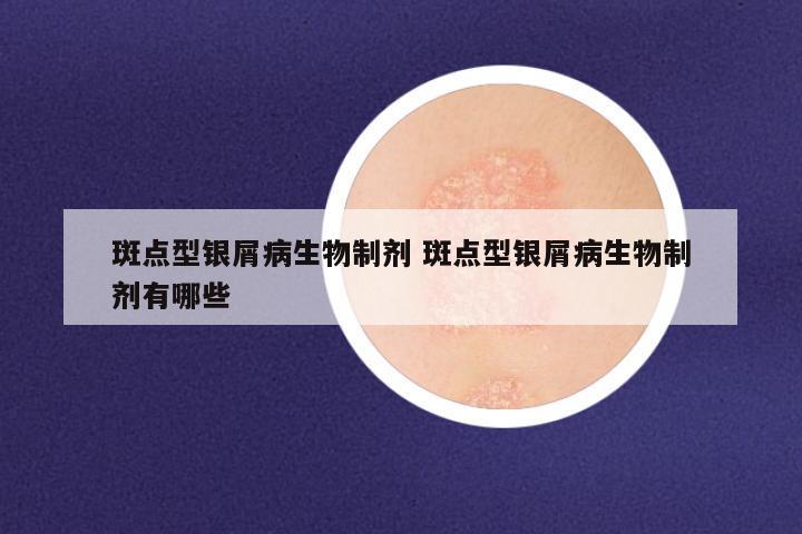 斑点型银屑病生物制剂 斑点型银屑病生物制剂有哪些