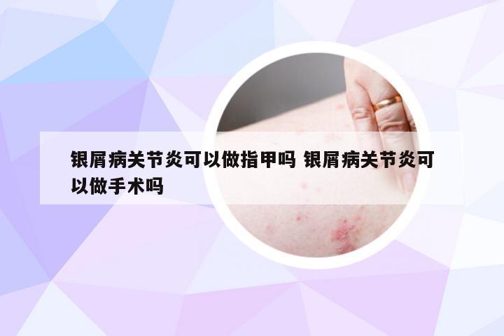 银屑病关节炎可以做指甲吗 银屑病关节炎可以做手术吗