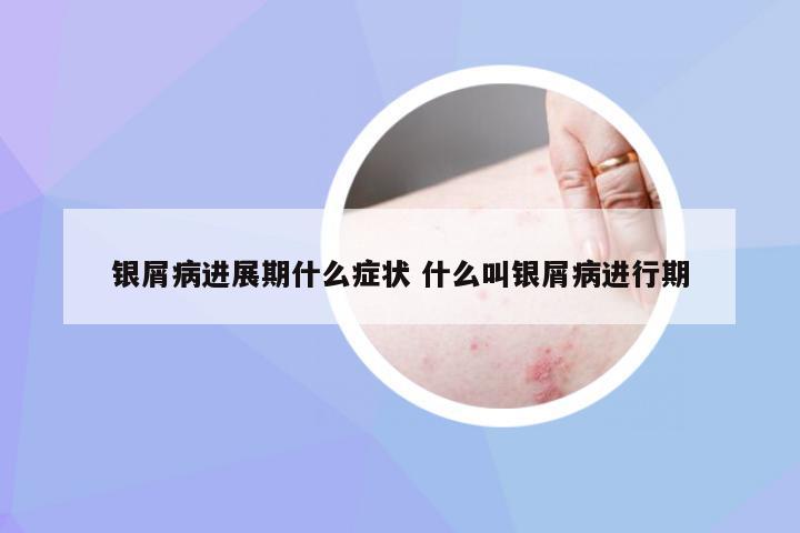 银屑病进展期什么症状 什么叫银屑病进行期