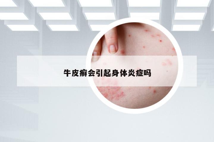 牛皮癣会引起身体炎症吗