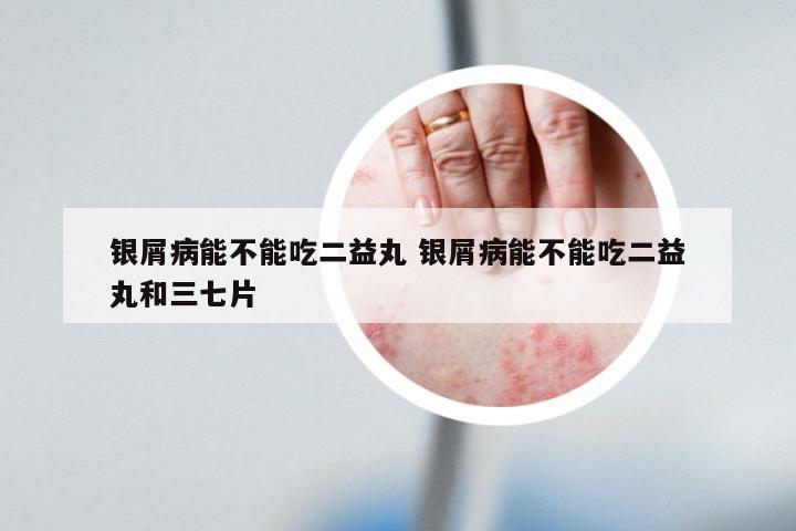 银屑病能不能吃二益丸 银屑病能不能吃二益丸和三七片