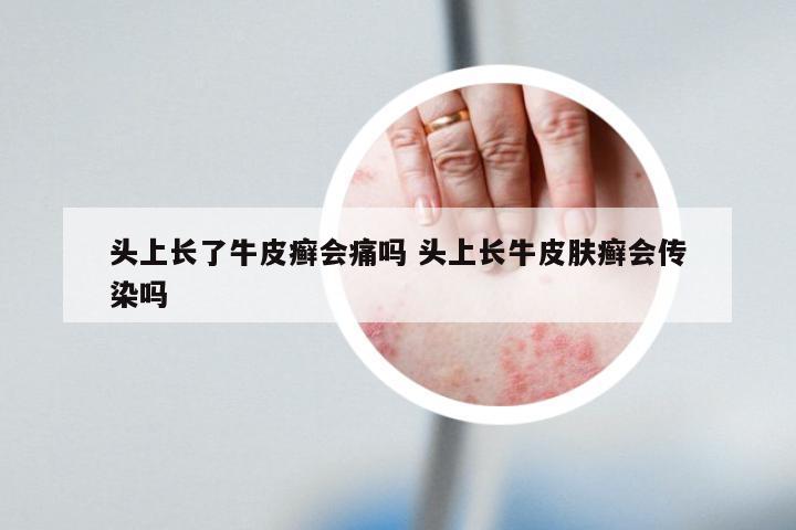 头上长了牛皮癣会痛吗 头上长牛皮肤癣会传染吗