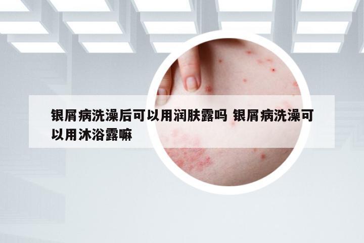 银屑病洗澡后可以用润肤露吗 银屑病洗澡可以用沐浴露嘛