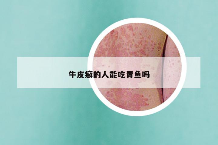 牛皮癣的人能吃青鱼吗