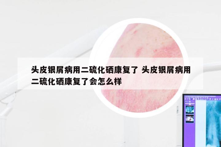 头皮银屑病用二硫化硒康复了 头皮银屑病用二硫化硒康复了会怎么样
