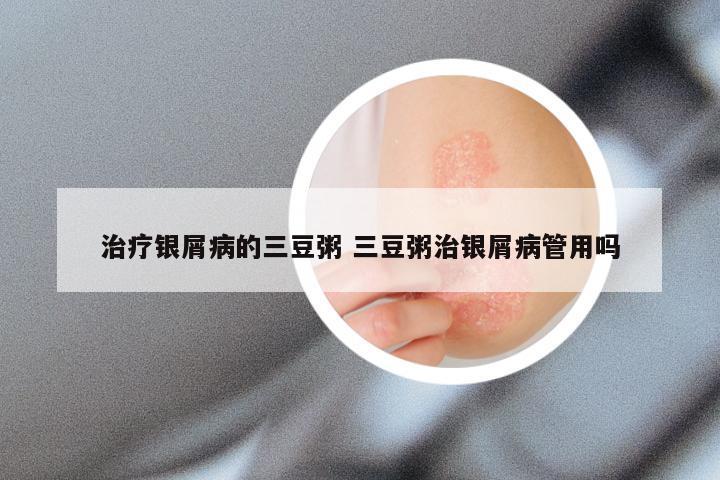治疗银屑病的三豆粥 三豆粥治银屑病管用吗