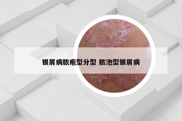 银屑病脓疱型分型 脓泡型银屑病