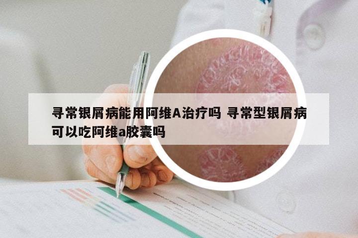 寻常银屑病能用阿维A治疗吗 寻常型银屑病可以吃阿维a胶囊吗