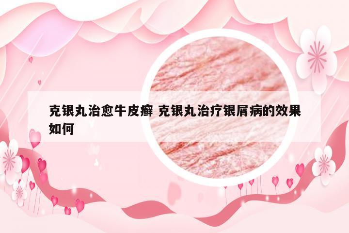 克银丸治愈牛皮癣 克银丸治疗银屑病的效果如何