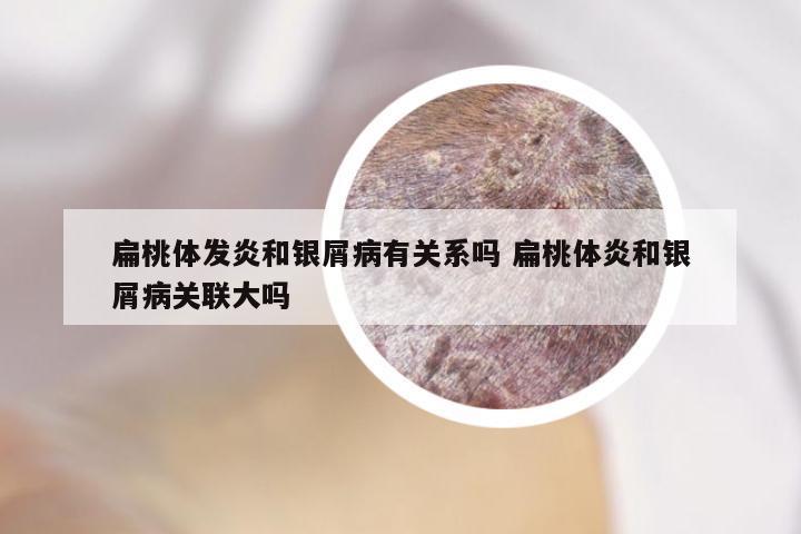 扁桃体发炎和银屑病有关系吗 扁桃体炎和银屑病关联大吗