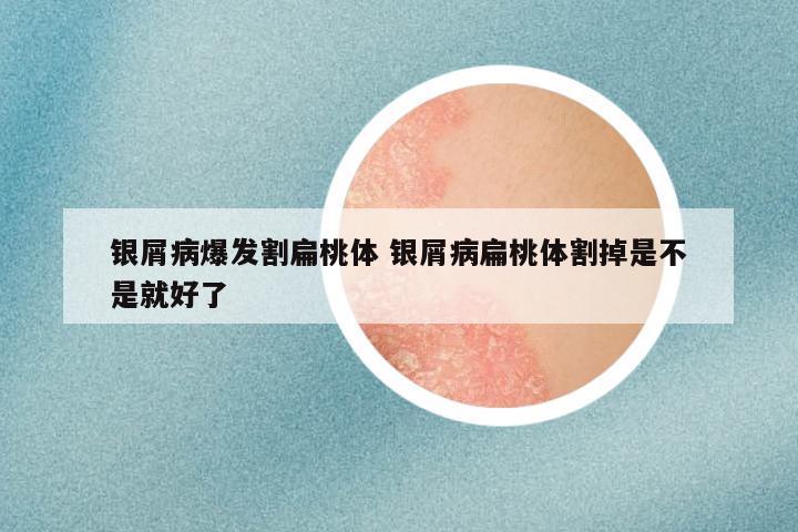 银屑病爆发割扁桃体 银屑病扁桃体割掉是不是就好了