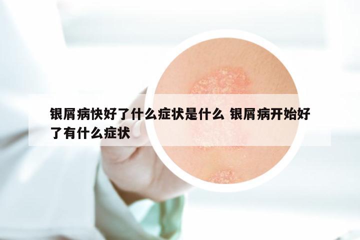 银屑病快好了什么症状是什么 银屑病开始好了有什么症状