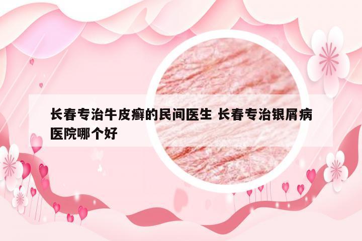 长春专治牛皮癣的民间医生 长春专治银屑病医院哪个好
