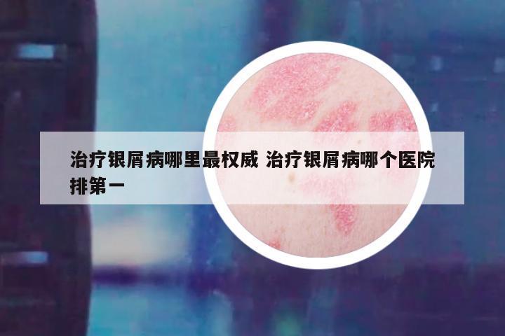 治疗银屑病哪里最权威 治疗银屑病哪个医院排第一