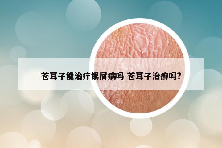 苍耳子能治疗银屑病吗 苍耳子治癣吗?