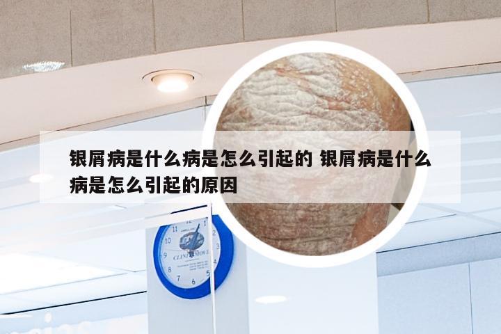 银屑病是什么病是怎么引起的 银屑病是什么病是怎么引起的原因