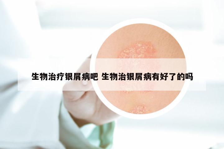 生物治疗银屑病吧 生物治银屑病有好了的吗