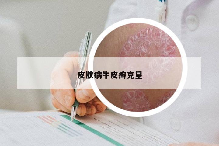 皮肤病牛皮癣克星
