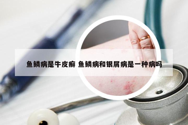 鱼鳞病是牛皮癣 鱼鳞病和银屑病是一种病吗