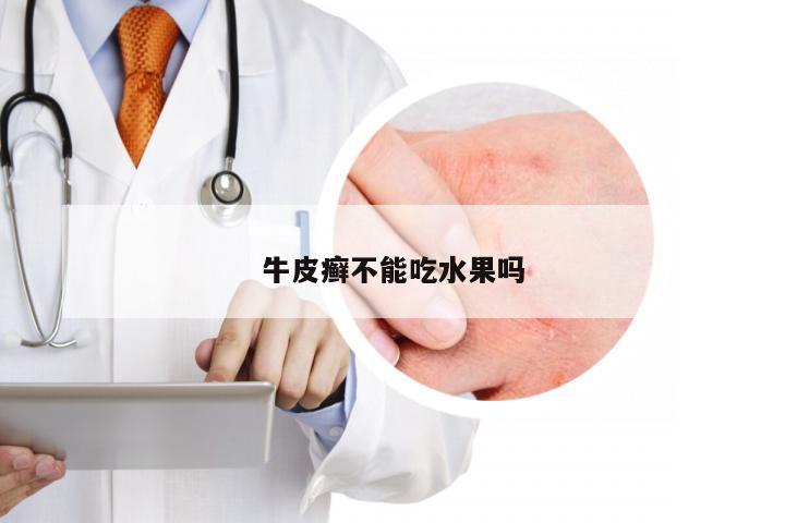 牛皮癣不能吃水果吗