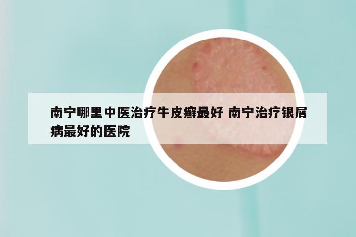 南宁哪里中医治疗牛皮癣最好 南宁治疗银屑病最好的医院