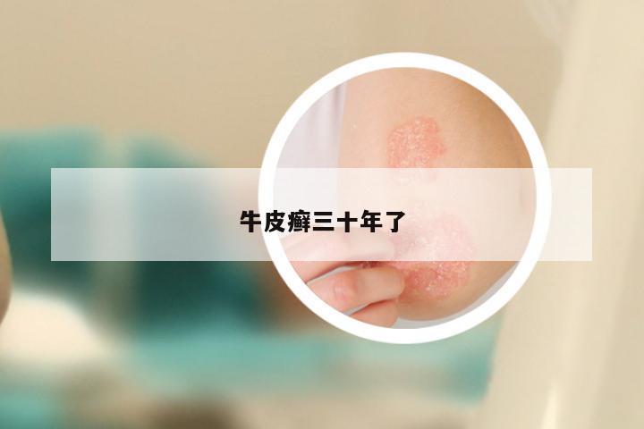 牛皮癣三十年了