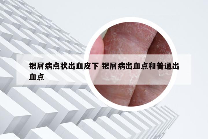银屑病点状出血皮下 银屑病出血点和普通出血点