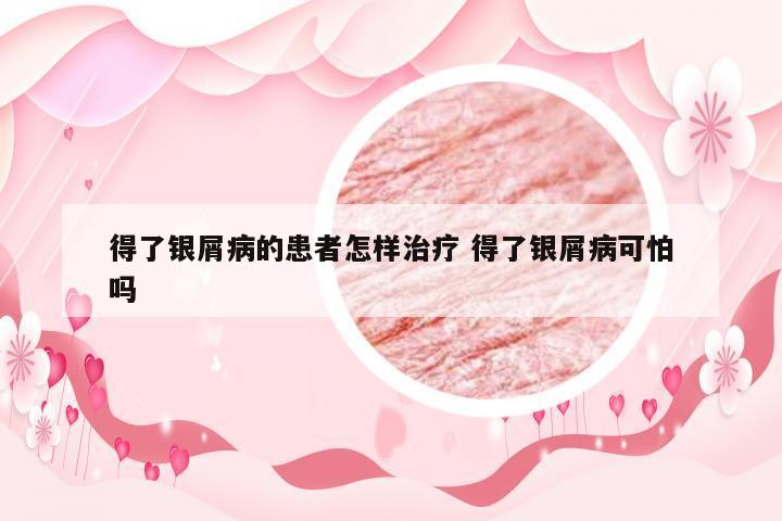 得了银屑病的患者怎样治疗 得了银屑病可怕吗