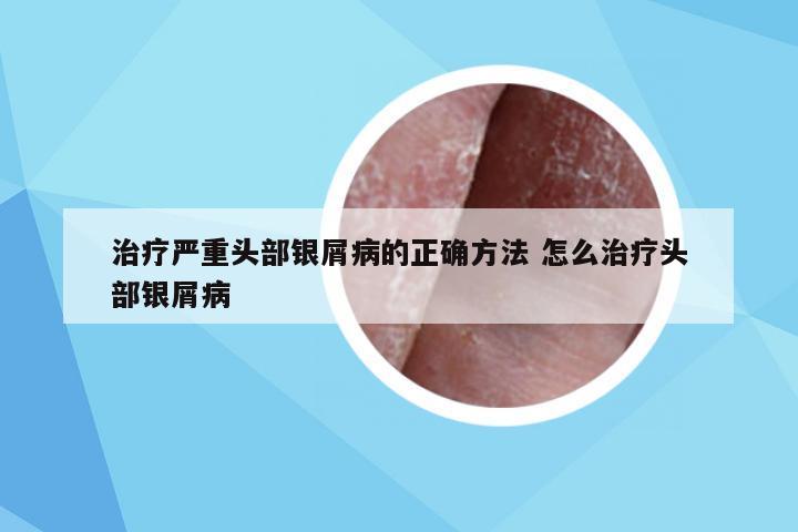 治疗严重头部银屑病的正确方法 怎么治疗头部银屑病