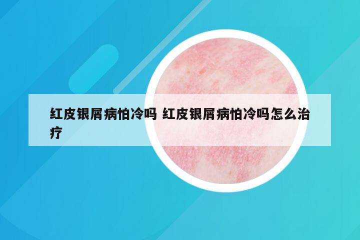 红皮银屑病怕冷吗 红皮银屑病怕冷吗怎么治疗