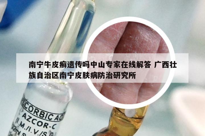 南宁牛皮癣遗传吗中山专家在线解答 广西壮族自治区南宁皮肤病防治研究所