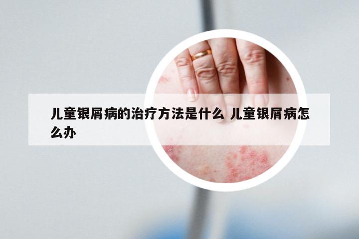 儿童银屑病的治疗方法是什么 儿童银屑病怎么办