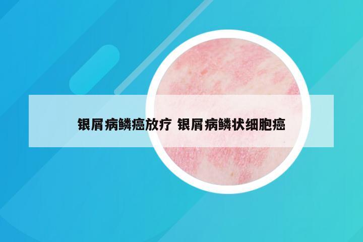 银屑病鳞癌放疗 银屑病鳞状细胞癌