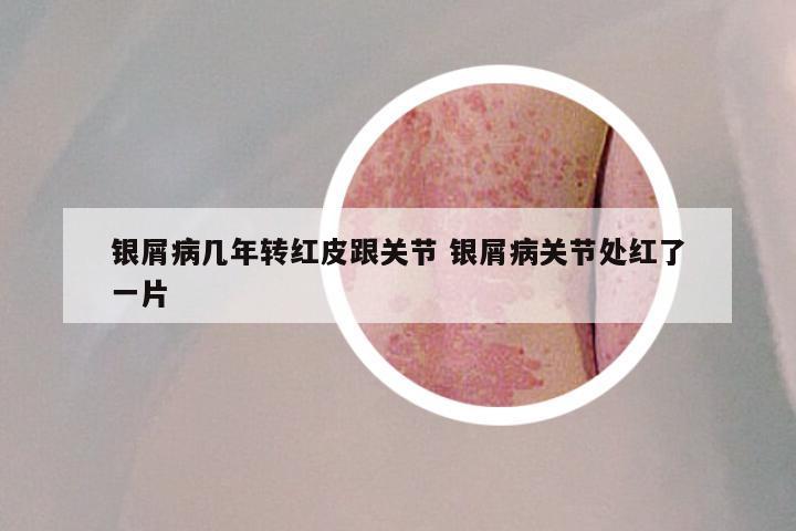 银屑病几年转红皮跟关节 银屑病关节处红了一片