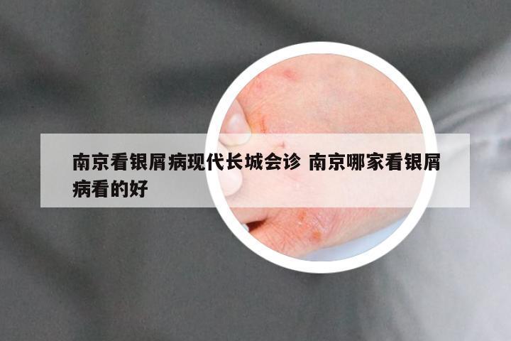 南京看银屑病现代长城会诊 南京哪家看银屑病看的好