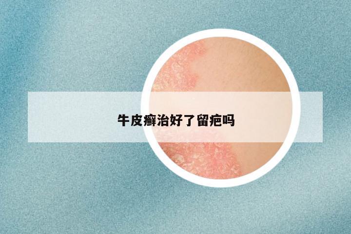 牛皮癣治好了留疤吗