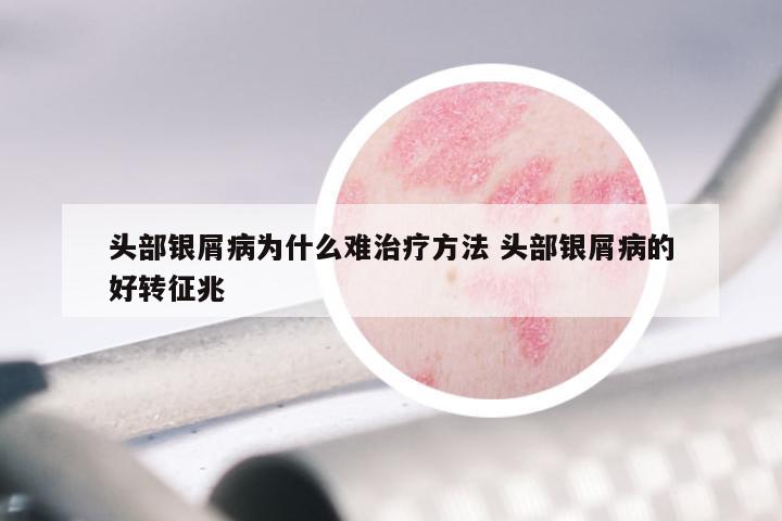 头部银屑病为什么难治疗方法 头部银屑病的好转征兆