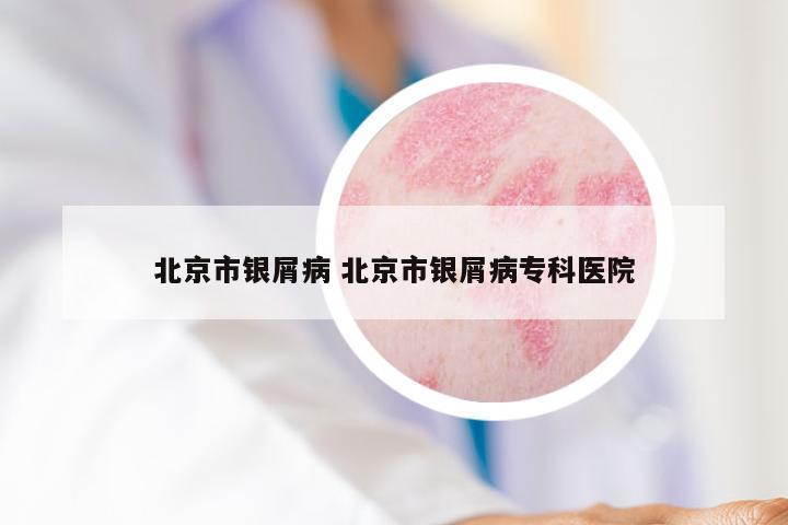 北京市银屑病 北京市银屑病专科医院