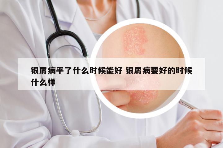 银屑病平了什么时候能好 银屑病要好的时候什么样