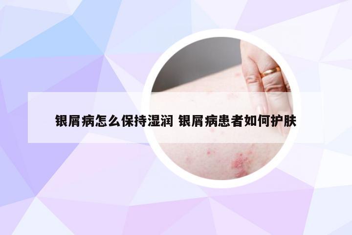 银屑病怎么保持湿润 银屑病患者如何护肤