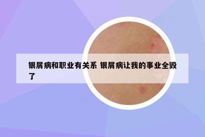 银屑病和职业有关系 银屑病让我的事业全毁了