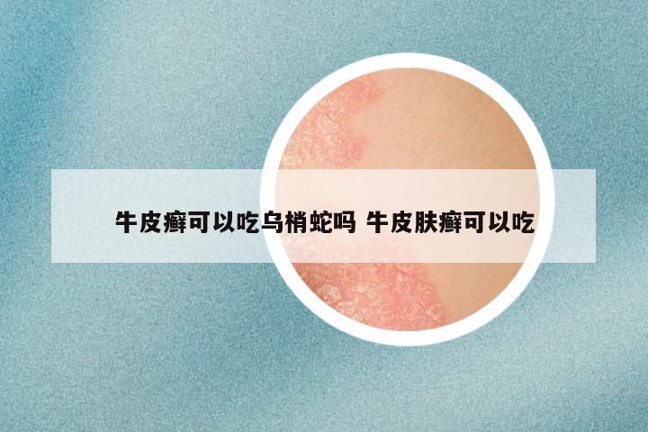 牛皮癣可以吃乌梢蛇吗 牛皮肤癣可以吃