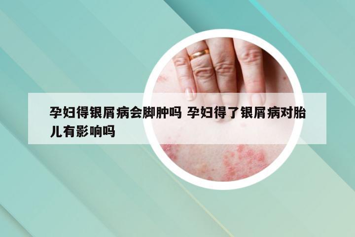 孕妇得银屑病会脚肿吗 孕妇得了银屑病对胎儿有影响吗