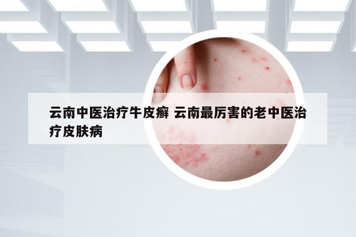 云南中医治疗牛皮癣 云南最厉害的老中医治疗皮肤病