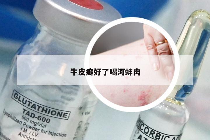 牛皮癣好了喝河蚌肉