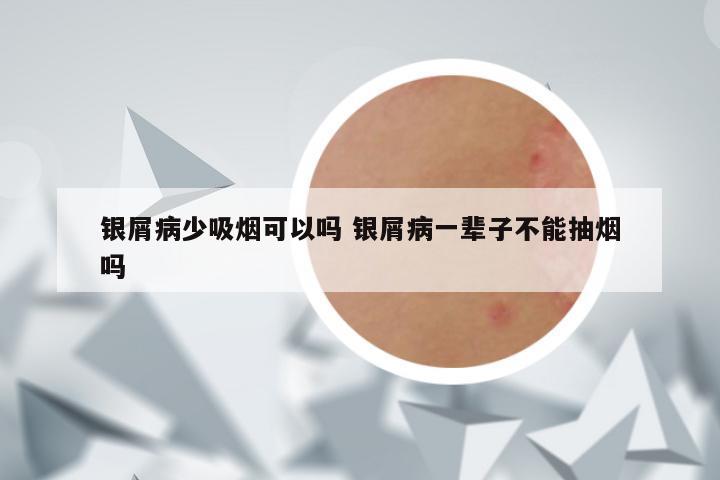 银屑病少吸烟可以吗 银屑病一辈子不能抽烟吗