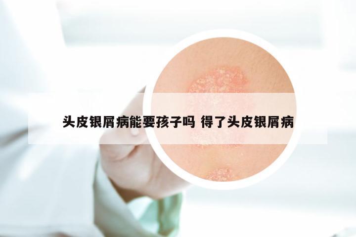 头皮银屑病能要孩子吗 得了头皮银屑病